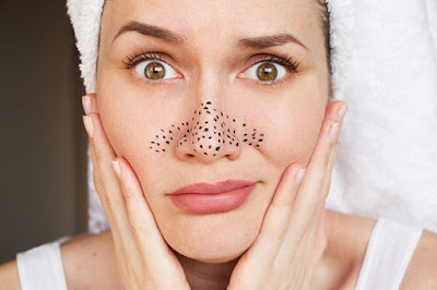 Strategies for Preventing & Treating Blackheads