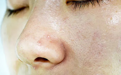 Skincare Tips for Oily Skin: A Comprehensive Guide