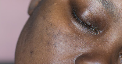 Addressing Skin Pigmentation Concerns in People of Color