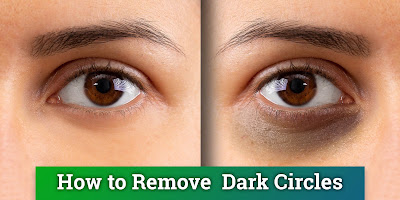 How to Prevent and Treat Dark Circles Under the Eyes