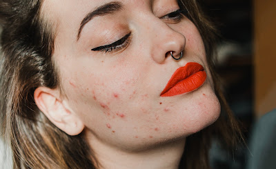 How Hormonal Changes During Menopause Affect the Skin
