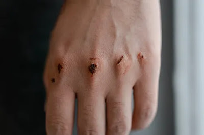 What is the Impact of CKD on Wound Healing?
