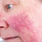 Addressing Redness and Rosacea