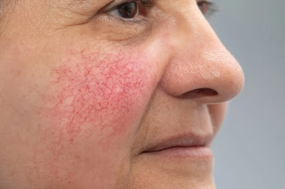 Skin Conditions Recommended Treatments