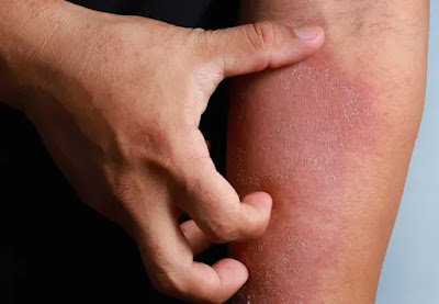 Skin Conditions Recommended Treatments