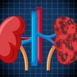 The Role of Inflammation in Kidney Disease Progression