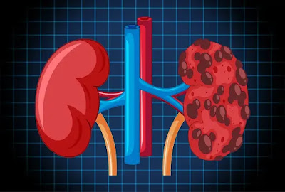 The Role of Inflammation in Kidney Disease Progression