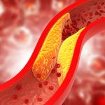 Managing High Cholesterol in CKD Patients