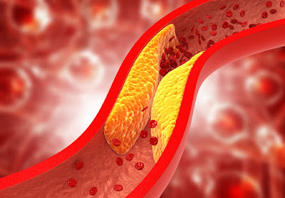 Managing High Cholesterol in CKD Patients