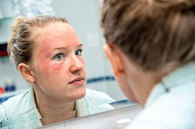 How to Treat and Prevent Skin Rashes