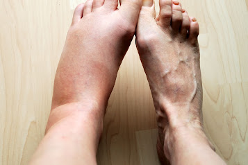 8 Earliest Signs Of Kidney Disease And How To Test Kidney Function
